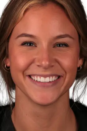 Patient proudly smiling after dark gum treatment for a brighter gum tone.